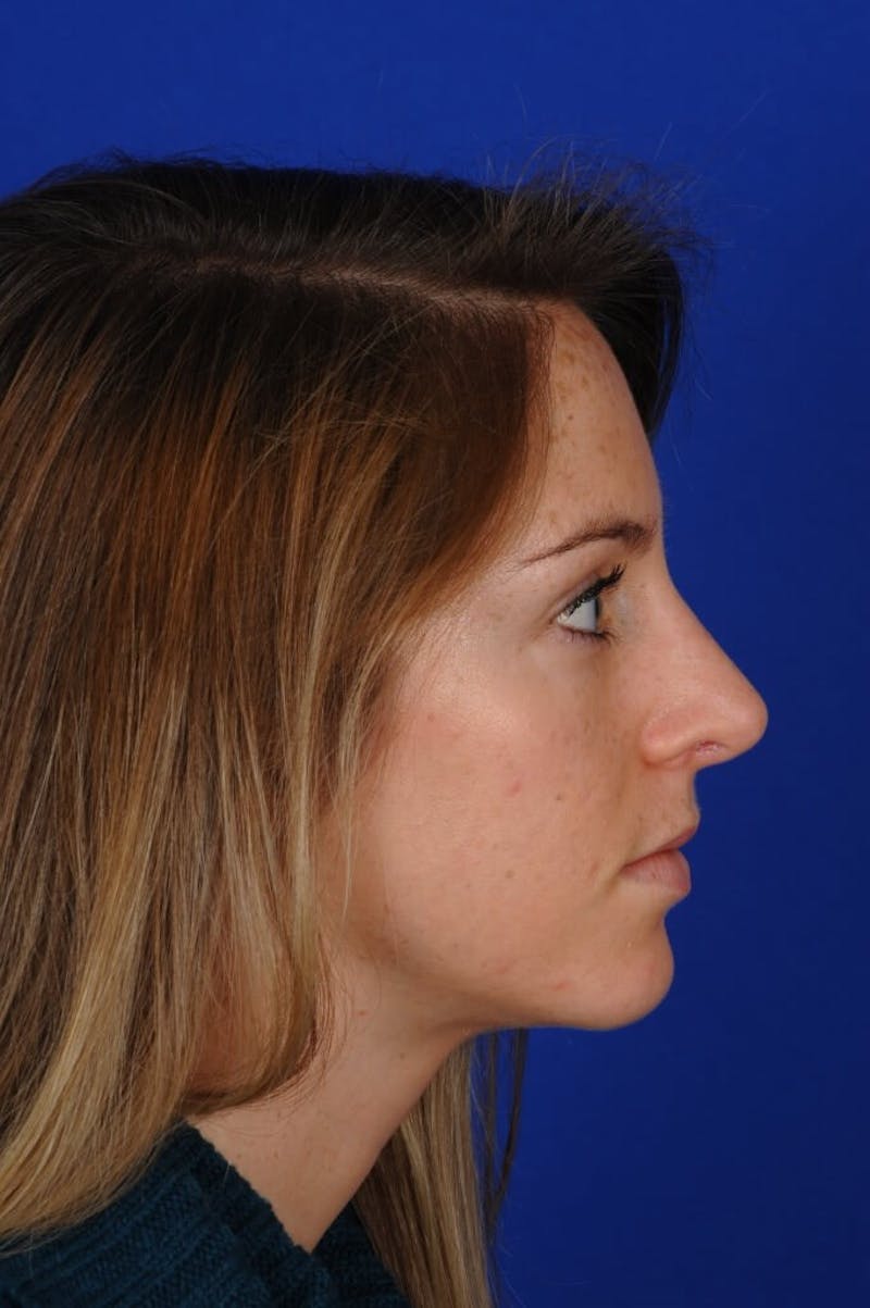 Rhinoplasty Before & After Gallery - Patient 406192 - Image 4