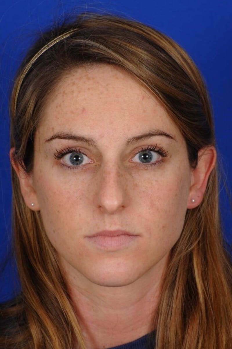 Rhinoplasty Before & After Gallery - Patient 406192 - Image 5