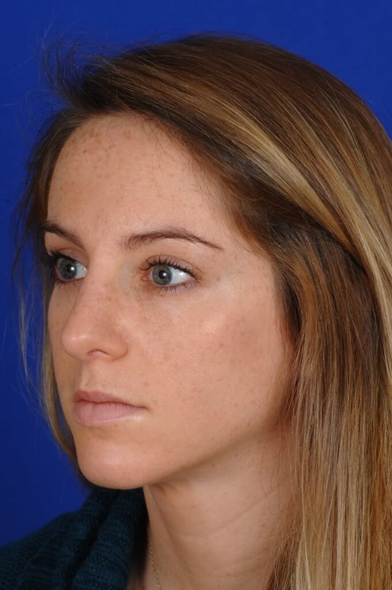 Rhinoplasty Before & After Gallery - Patient 406192 - Image 8
