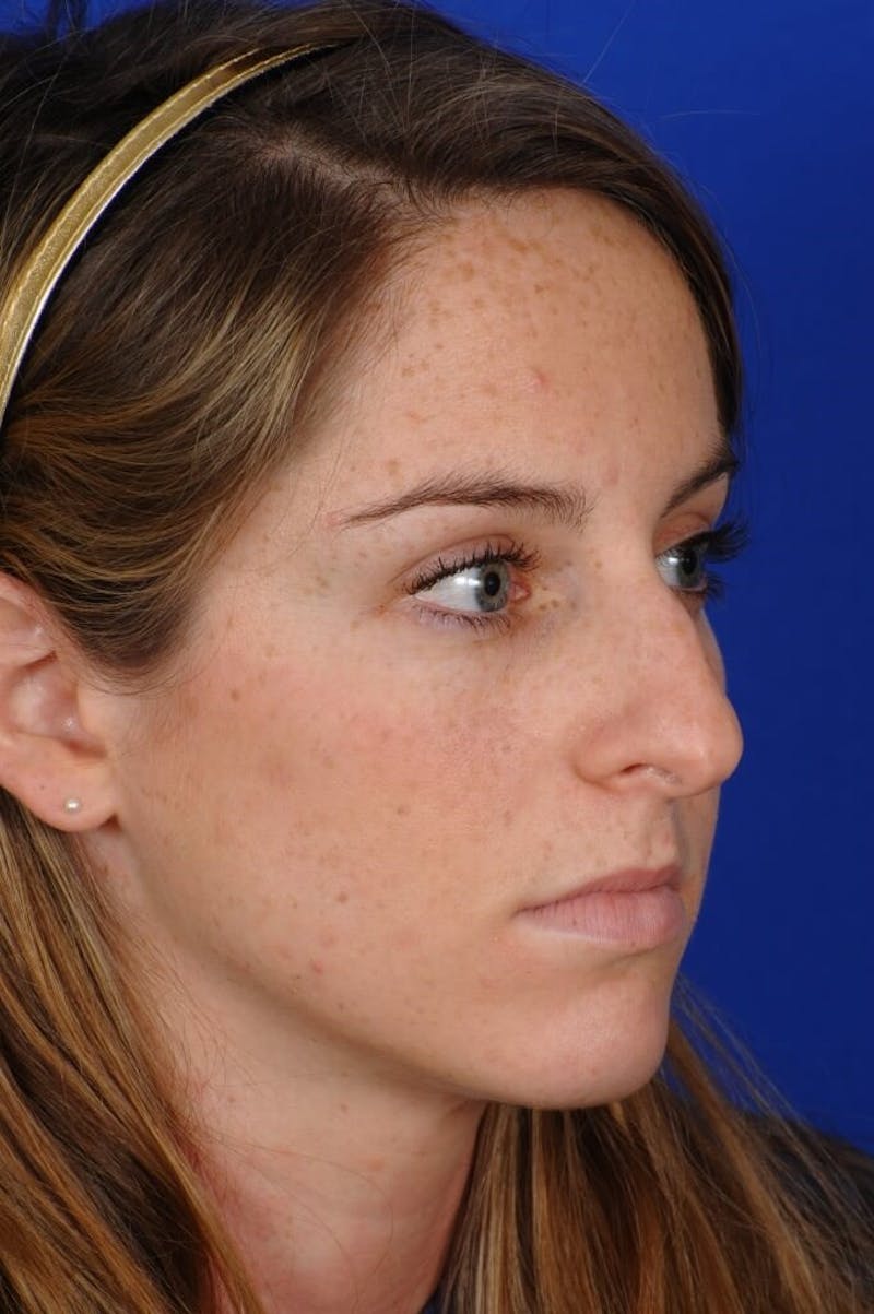 Rhinoplasty Before & After Gallery - Patient 406192 - Image 9