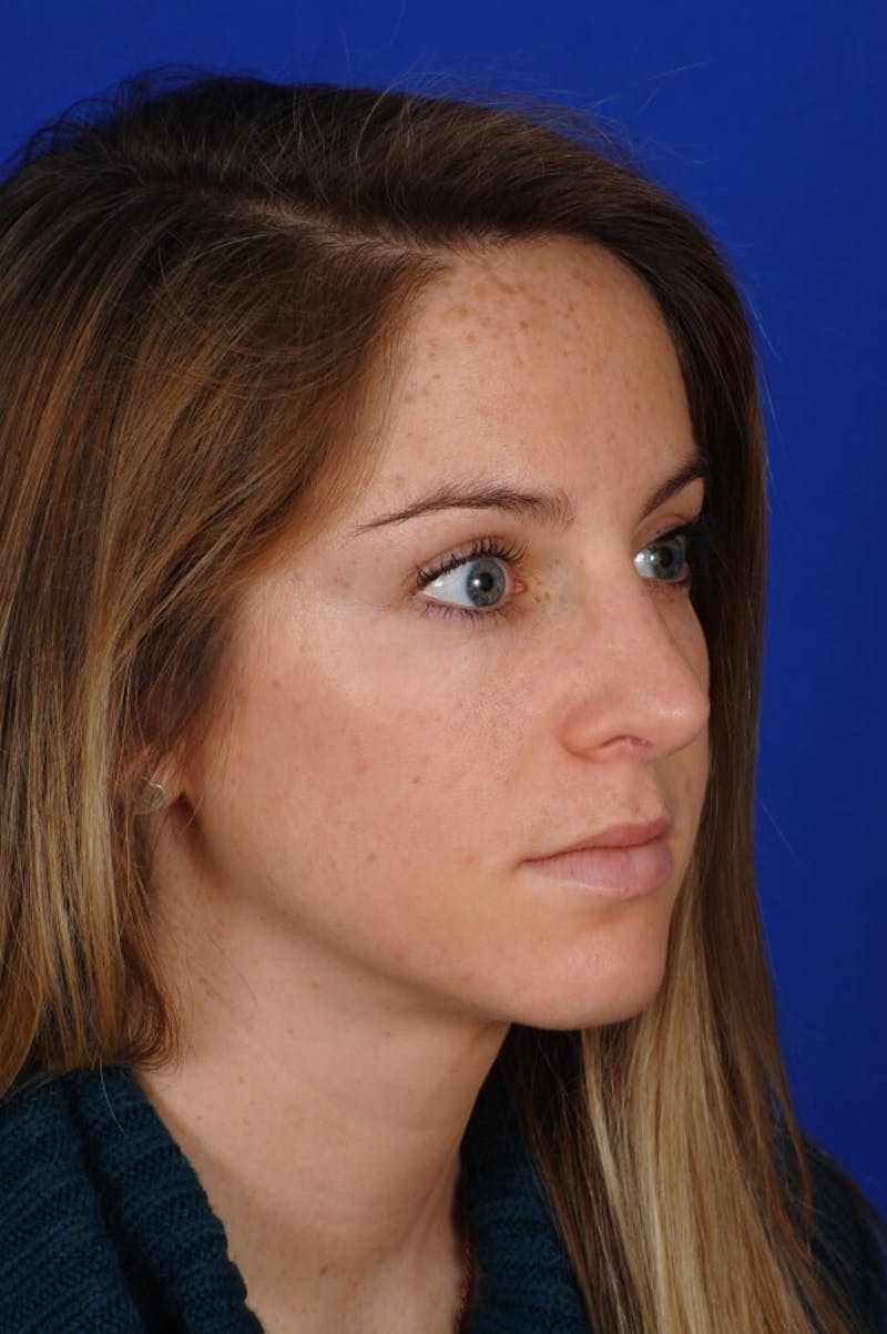 Rhinoplasty Before & After Gallery - Patient 406192 - Image 10