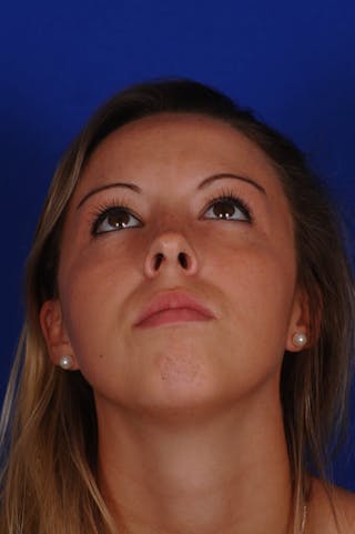 Rhinoplasty Before & After Gallery - Patient 416362 - Image 8