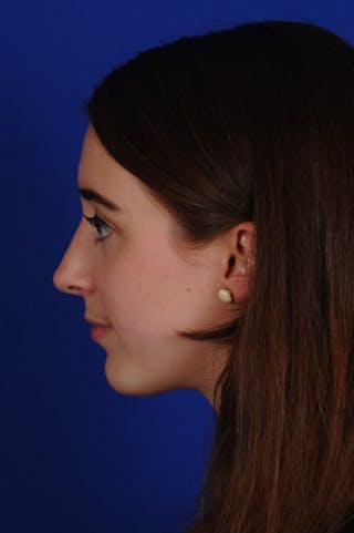 Rhinoplasty Before & After Gallery - Patient 251985 - Image 4