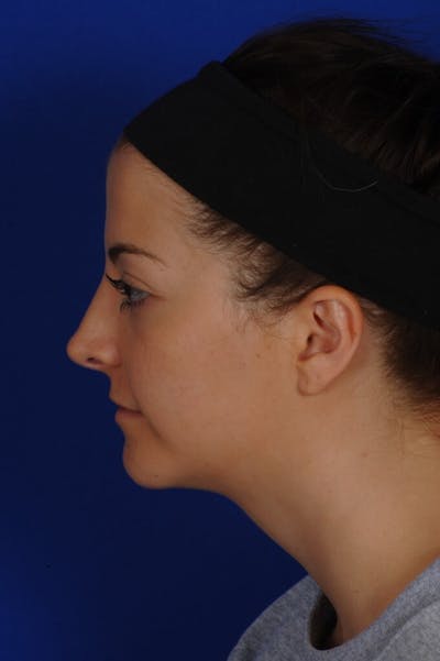 Rhinoplasty Before & After Gallery - Patient 241847 - Image 2