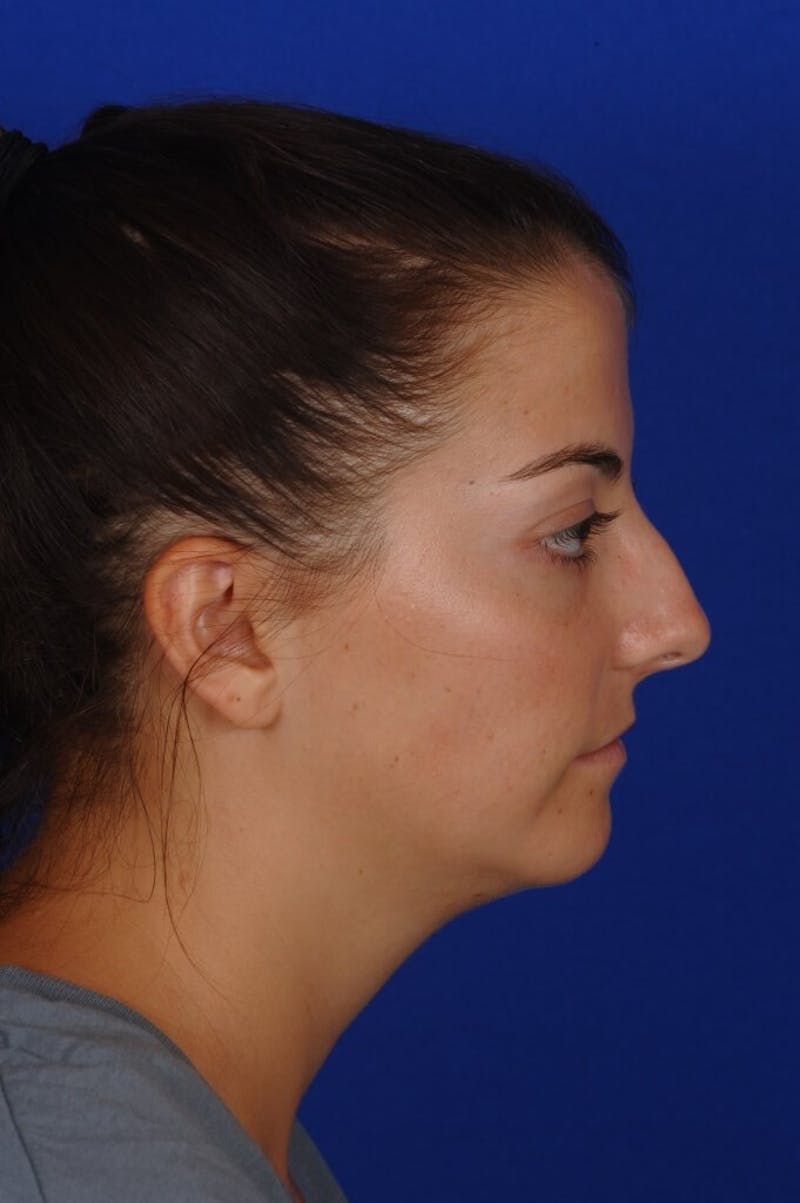 Rhinoplasty Before & After Gallery - Patient 241847 - Image 9