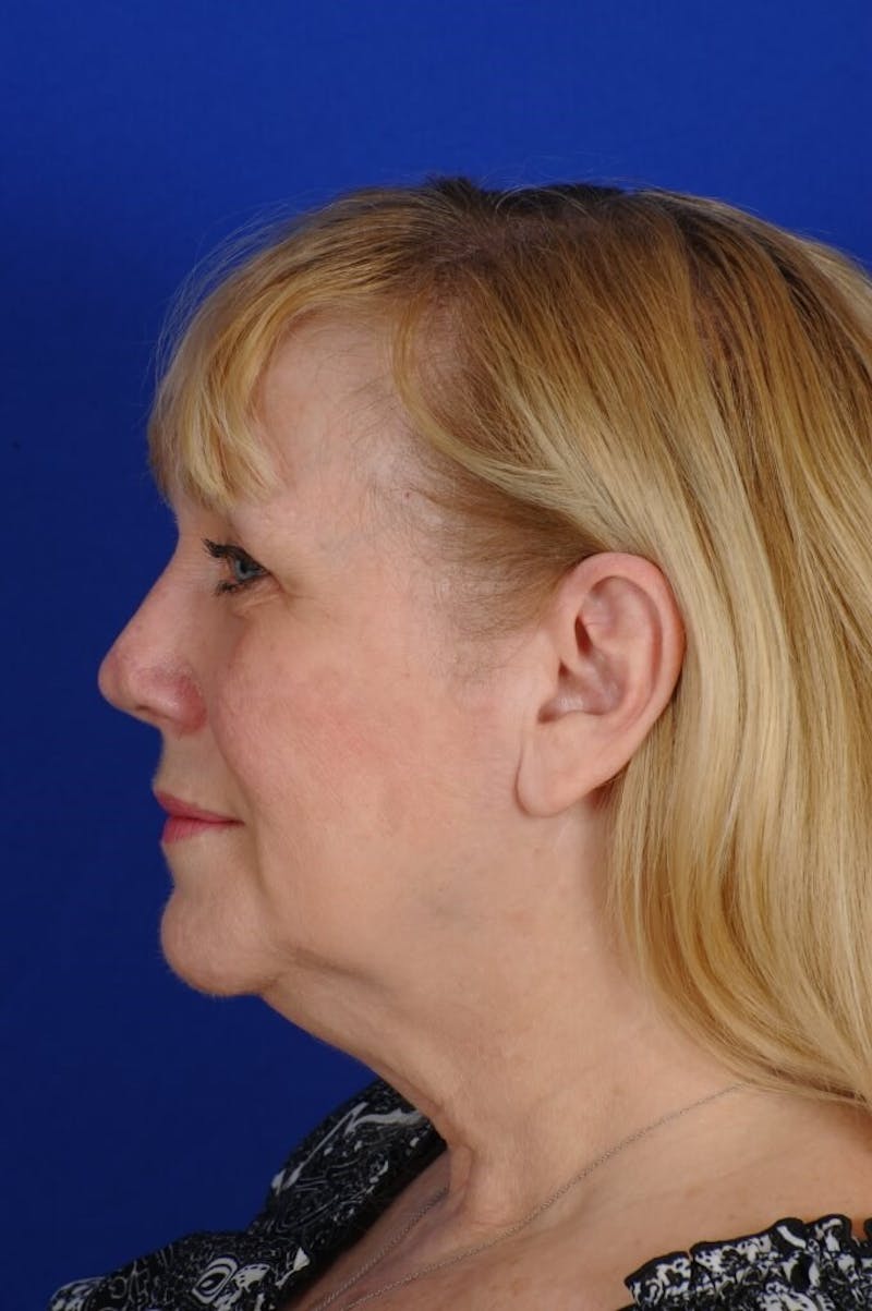Rhinoplasty Before & After Gallery - Patient 242147 - Image 1