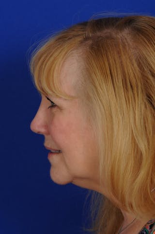 Rhinoplasty Before & After Gallery - Patient 242147 - Image 2