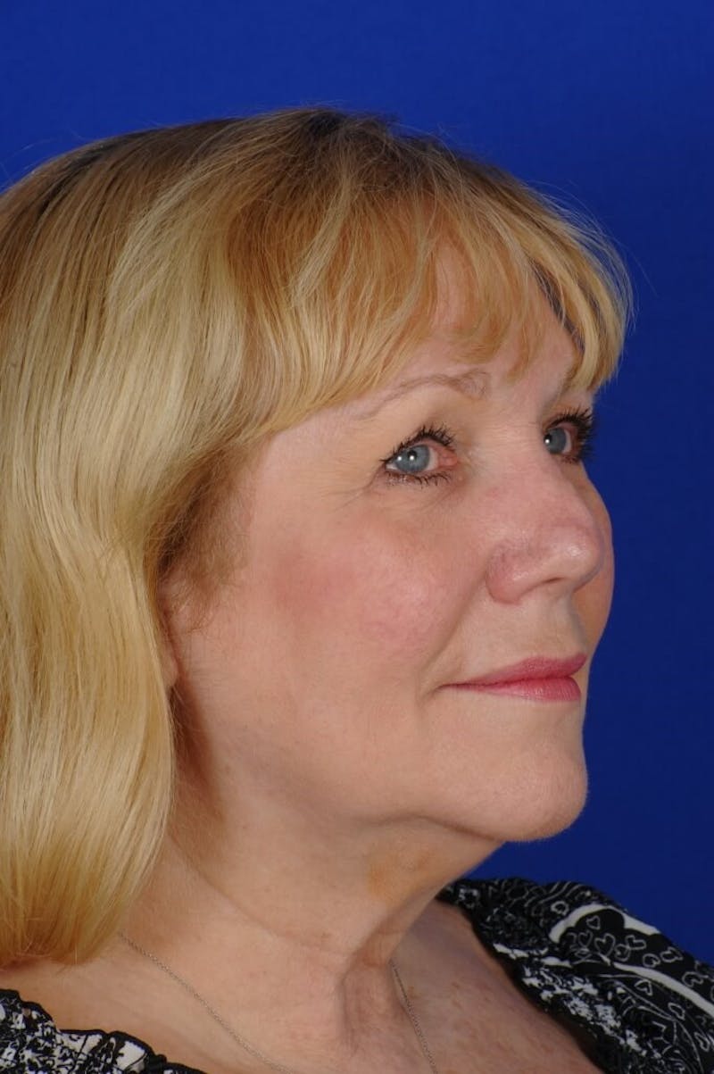 Rhinoplasty Before & After Gallery - Patient 242147 - Image 3