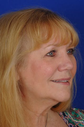 Rhinoplasty Before & After Gallery - Patient 242147 - Image 4