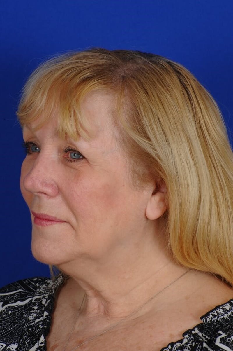Rhinoplasty Before & After Gallery - Patient 242147 - Image 5