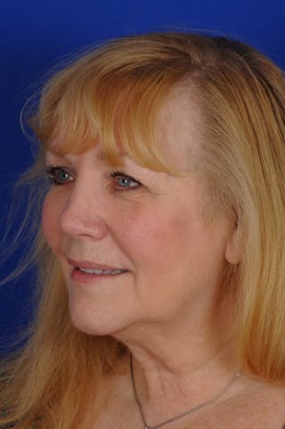 Rhinoplasty Before & After Gallery - Patient 242147 - Image 6