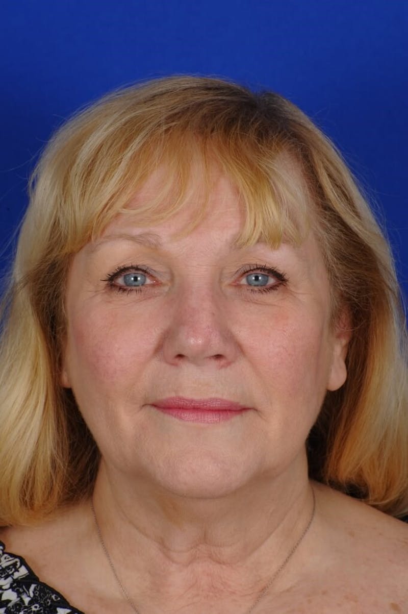 Rhinoplasty Before & After Gallery - Patient 242147 - Image 7