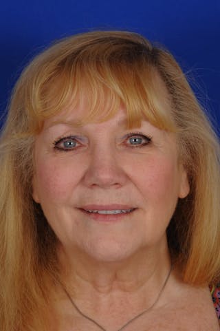 Rhinoplasty Before & After Gallery - Patient 242147 - Image 8