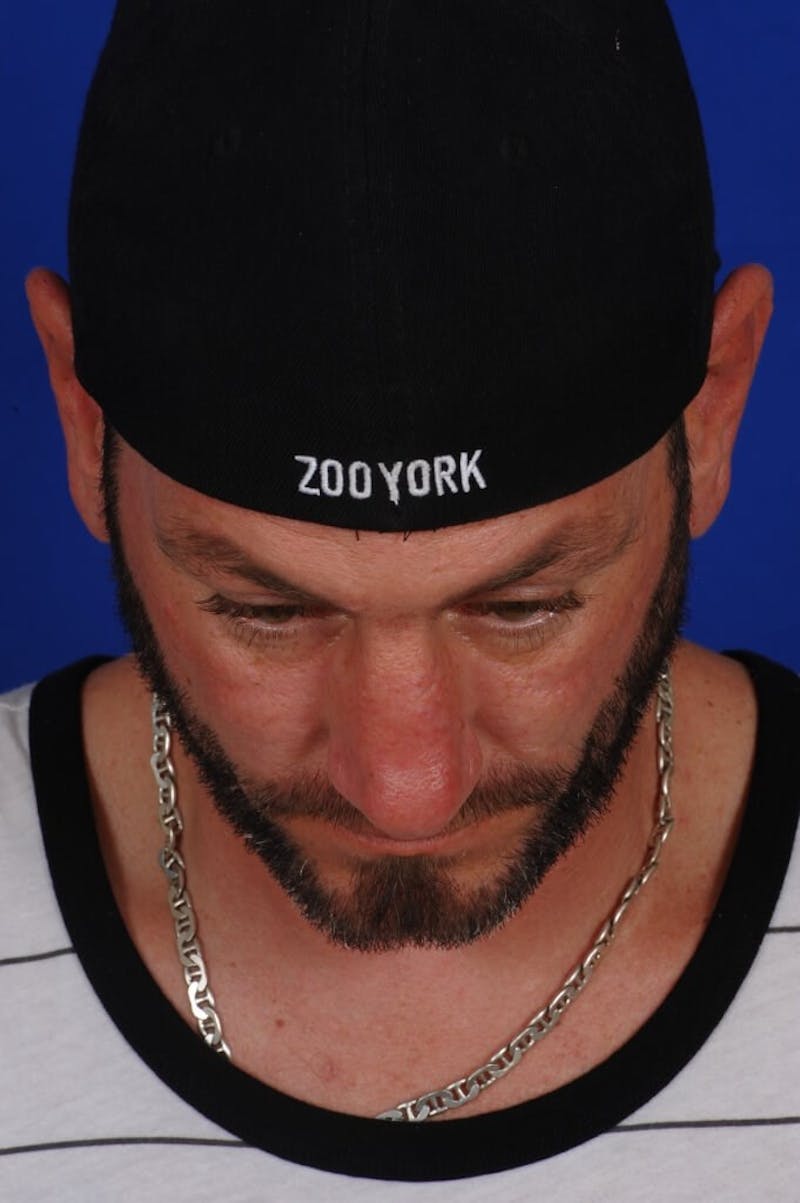 Rhinoplasty Before & After Gallery - Patient 357946 - Image 6