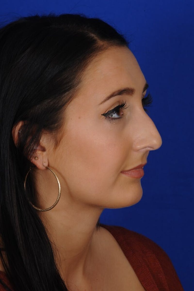Rhinoplasty Before & After Gallery - Patient 368200 - Image 1