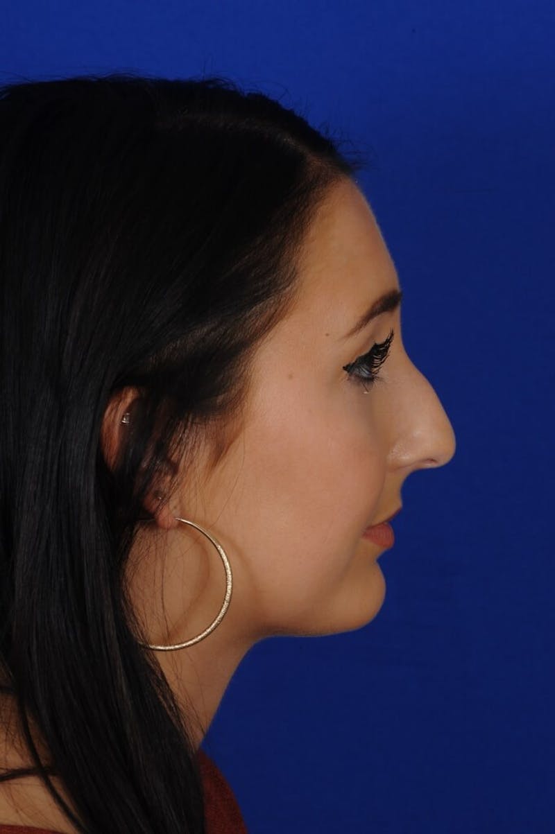 Rhinoplasty Before & After Gallery - Patient 368200 - Image 3
