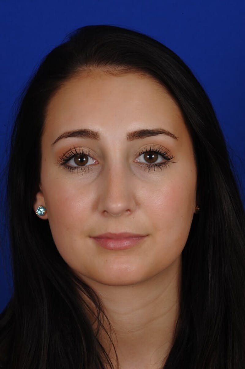 Rhinoplasty Before & After Gallery - Patient 368200 - Image 6