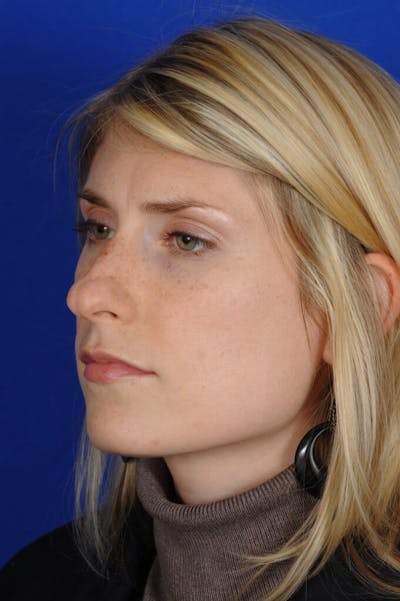 Rhinoplasty Before & After Gallery - Patient 164261 - Image 1
