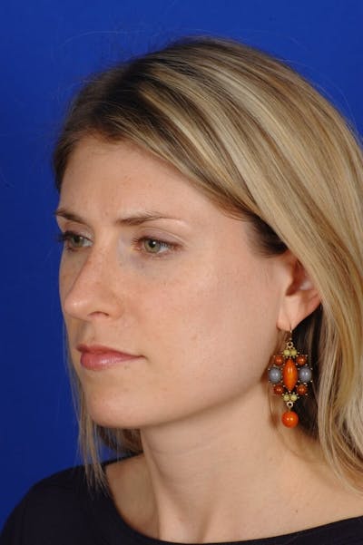 Rhinoplasty Before & After Gallery - Patient 164261 - Image 2