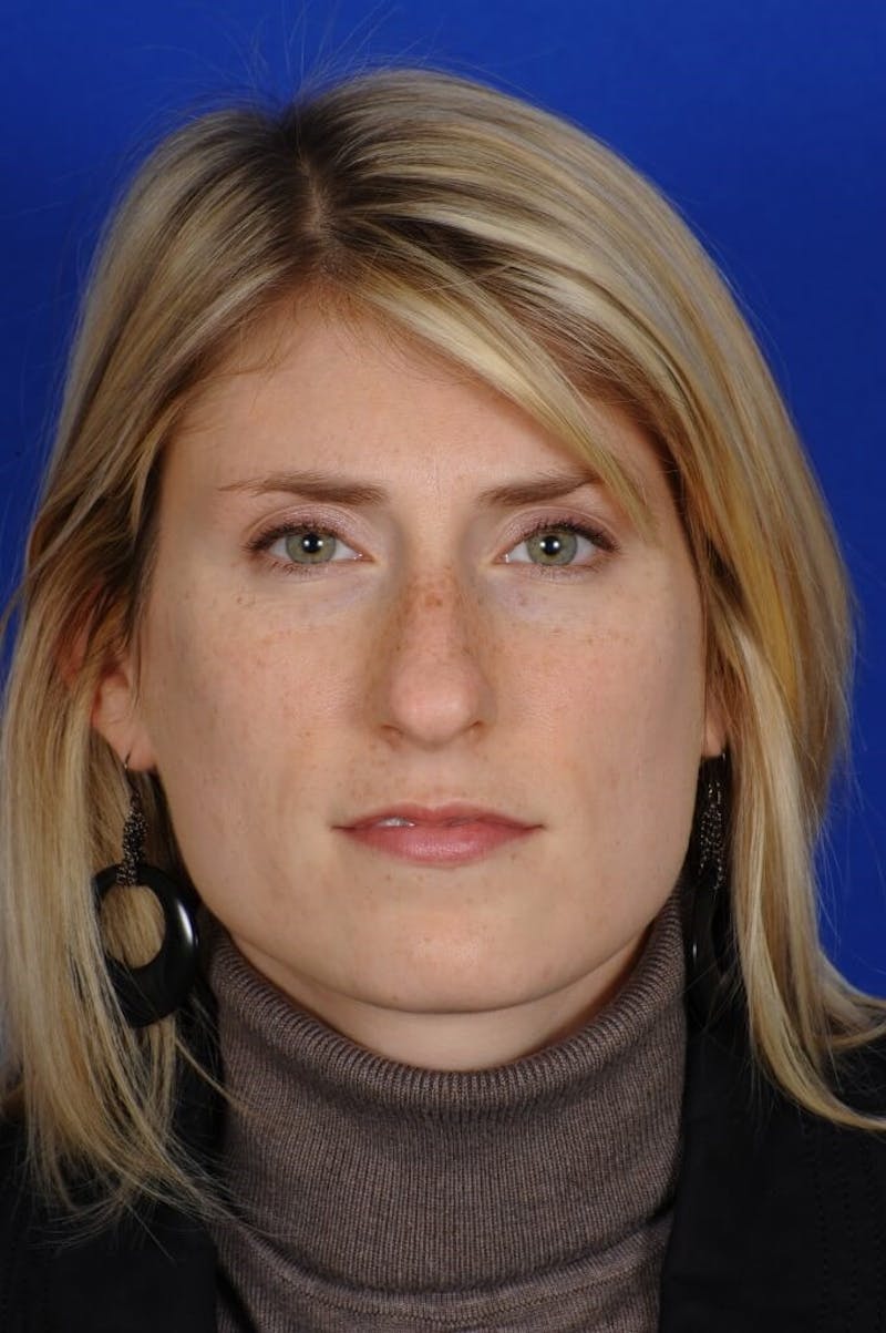 Rhinoplasty Before & After Gallery - Patient 164261 - Image 3