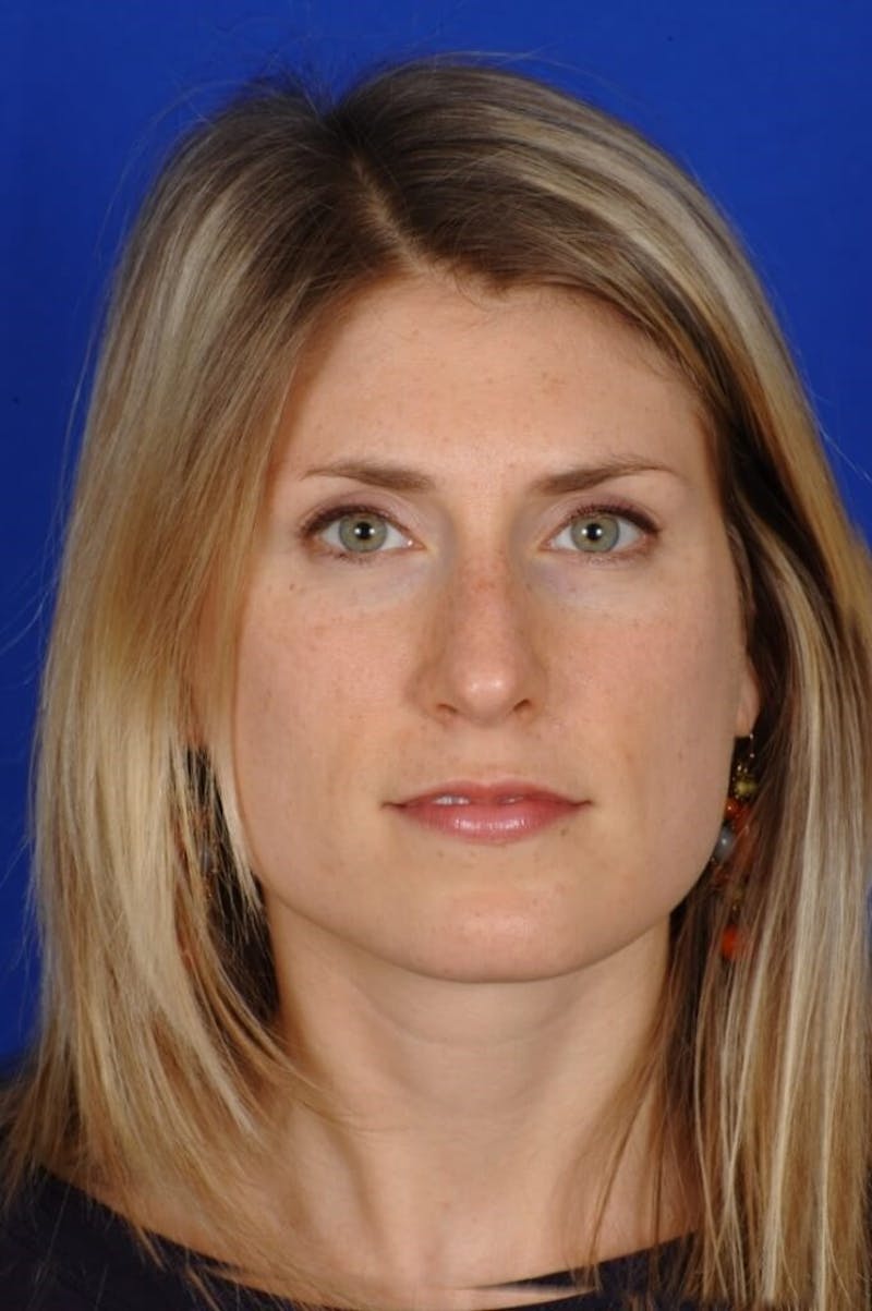 Rhinoplasty Before & After Gallery - Patient 164261 - Image 4