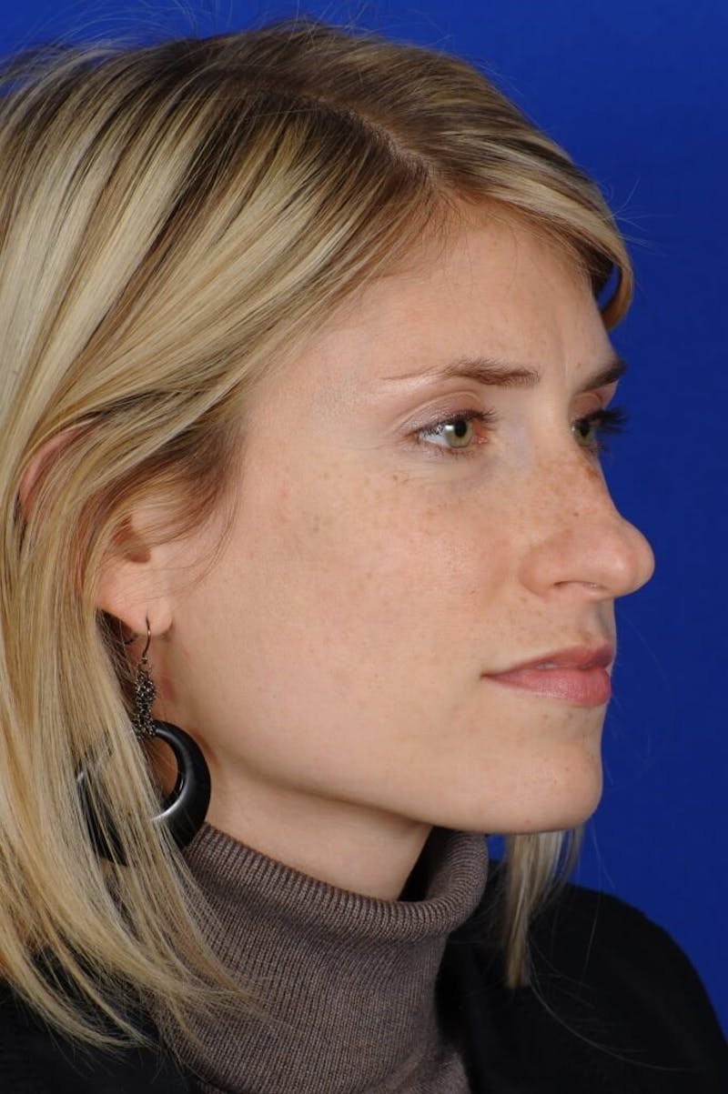 Rhinoplasty Before & After Gallery - Patient 164261 - Image 5