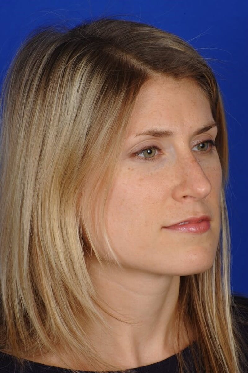 Rhinoplasty Before & After Gallery - Patient 164261 - Image 6