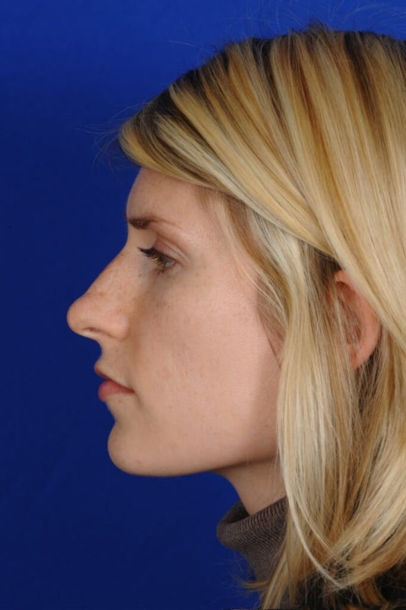 Rhinoplasty Before & After Gallery - Patient 164261 - Image 7