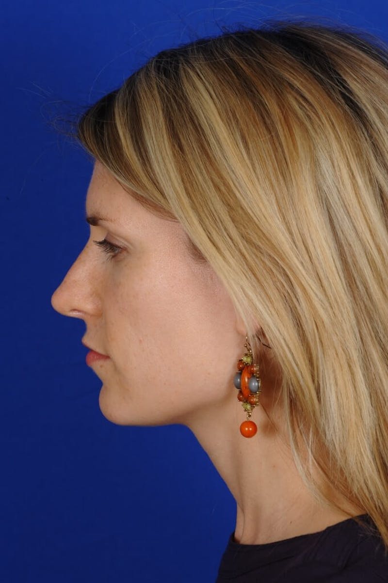 Rhinoplasty Before & After Gallery - Patient 164261 - Image 8