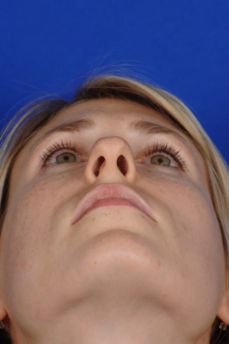 Rhinoplasty Before & After Gallery - Patient 164261 - Image 9