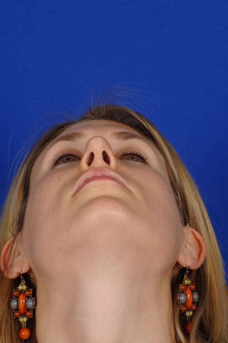 Rhinoplasty Before & After Gallery - Patient 164261 - Image 10