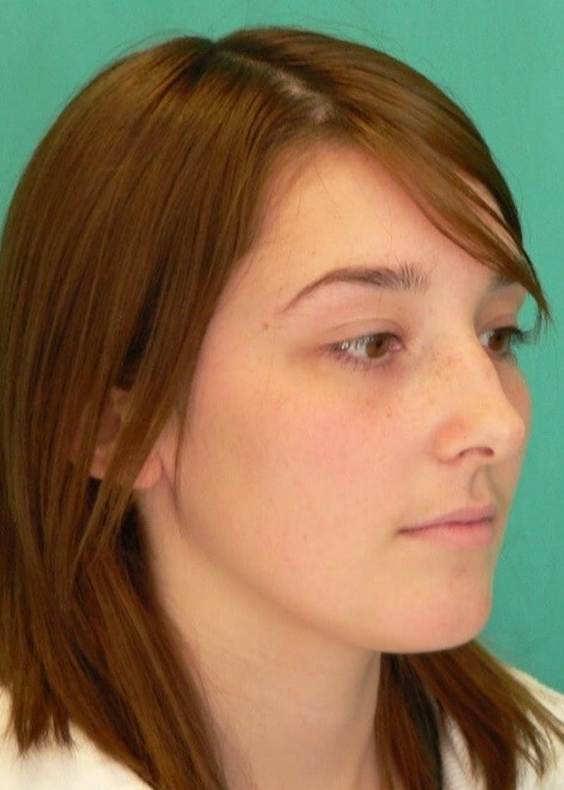 Rhinoplasty Before & After Gallery - Patient 961019 - Image 1