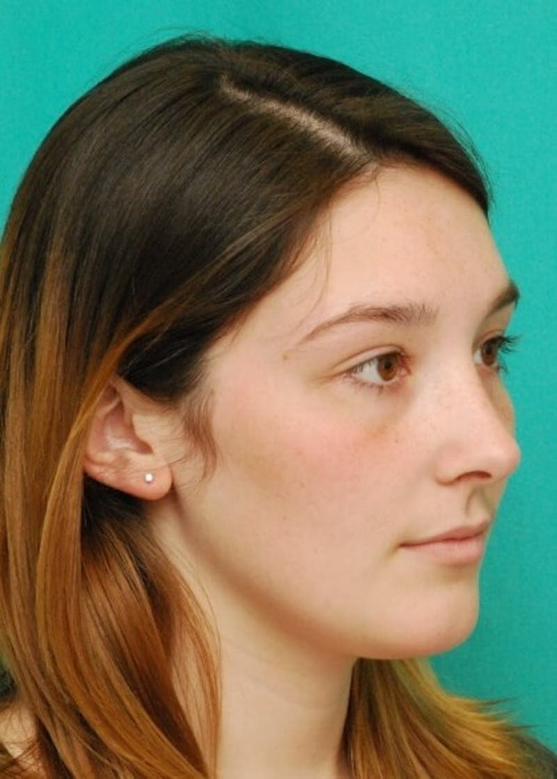 Rhinoplasty Before & After Gallery - Patient 961019 - Image 2