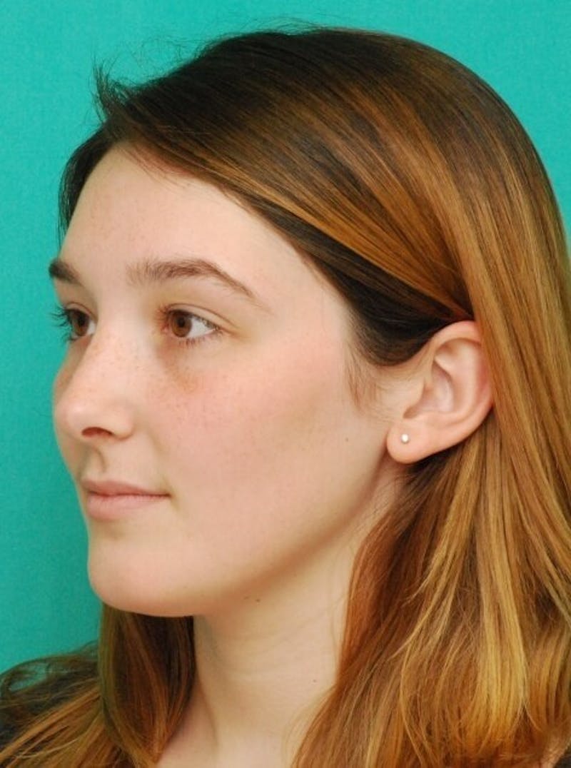 Rhinoplasty Before & After Gallery - Patient 961019 - Image 4
