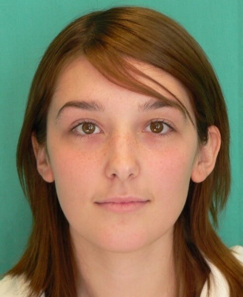 Rhinoplasty Before & After Gallery - Patient 961019 - Image 5