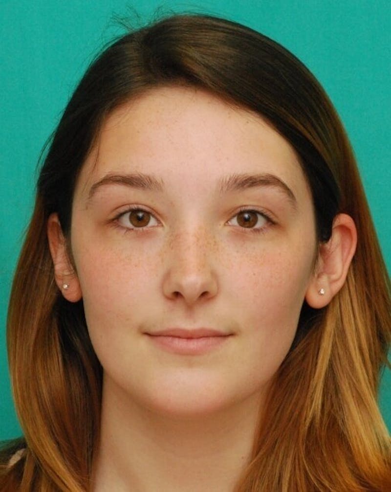 Rhinoplasty Before & After Gallery - Patient 961019 - Image 6