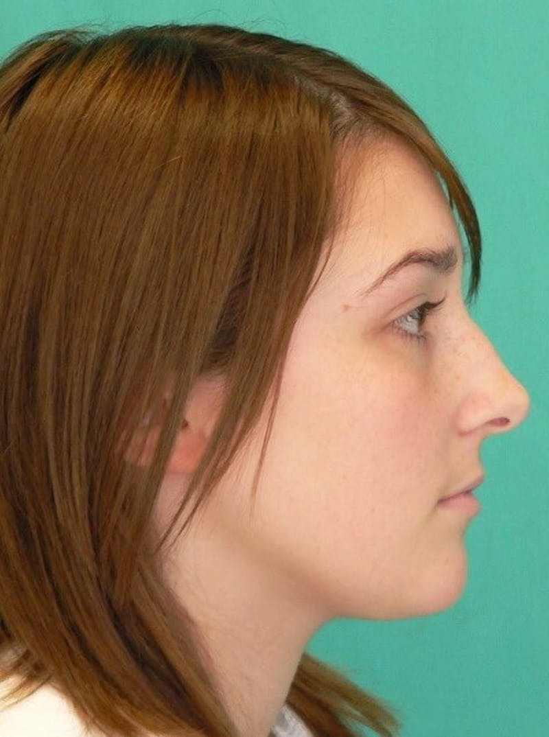 Rhinoplasty Before & After Gallery - Patient 961019 - Image 7