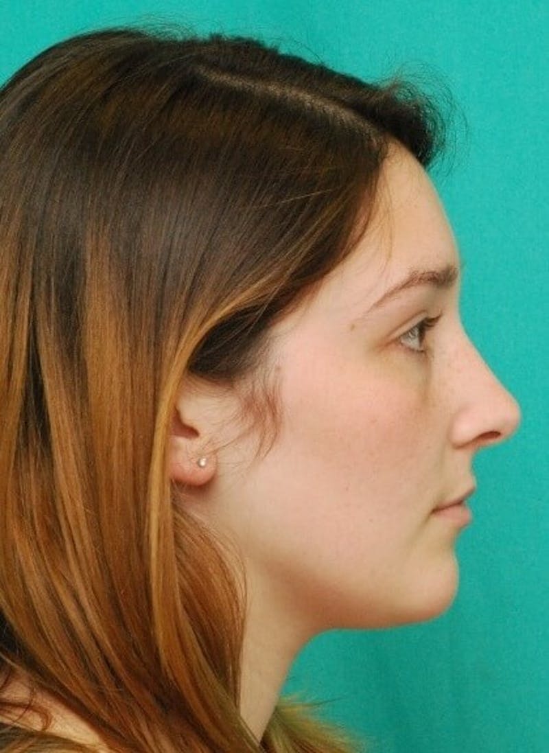Rhinoplasty Before & After Gallery - Patient 961019 - Image 8
