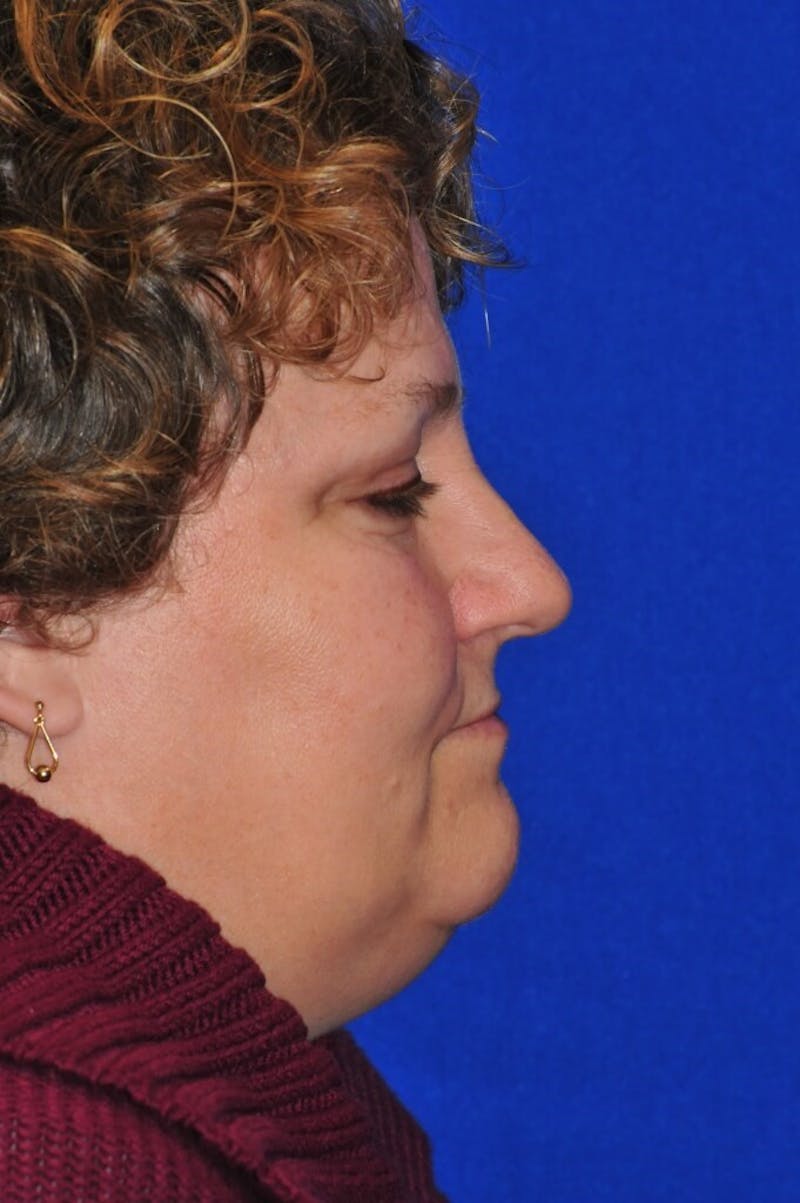 Rhinoplasty Before & After Gallery - Patient 112287 - Image 4