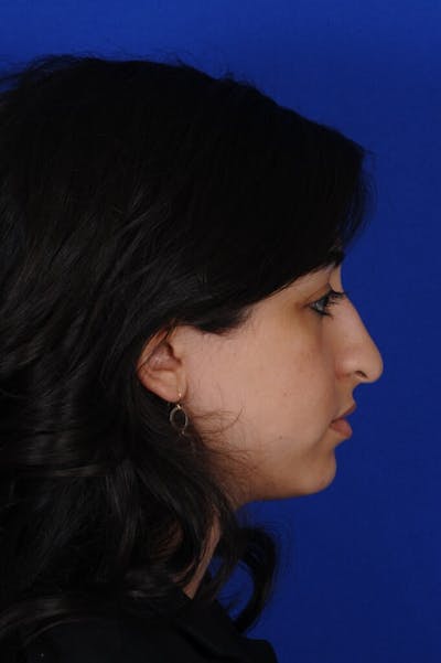 Rhinoplasty Before & After Gallery - Patient 126253 - Image 1