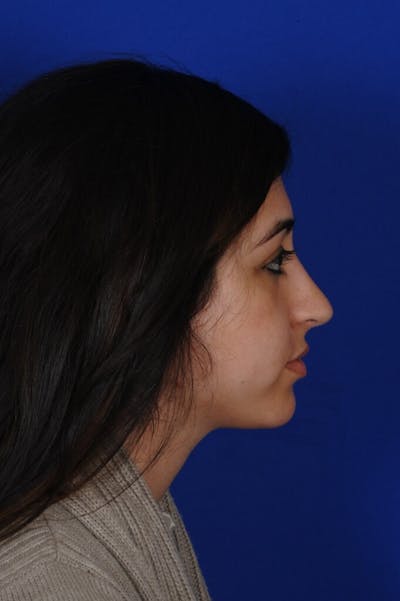 Rhinoplasty Before & After Gallery - Patient 126253 - Image 2