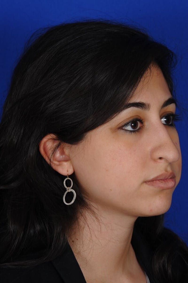 Rhinoplasty Before & After Gallery - Patient 126253 - Image 3