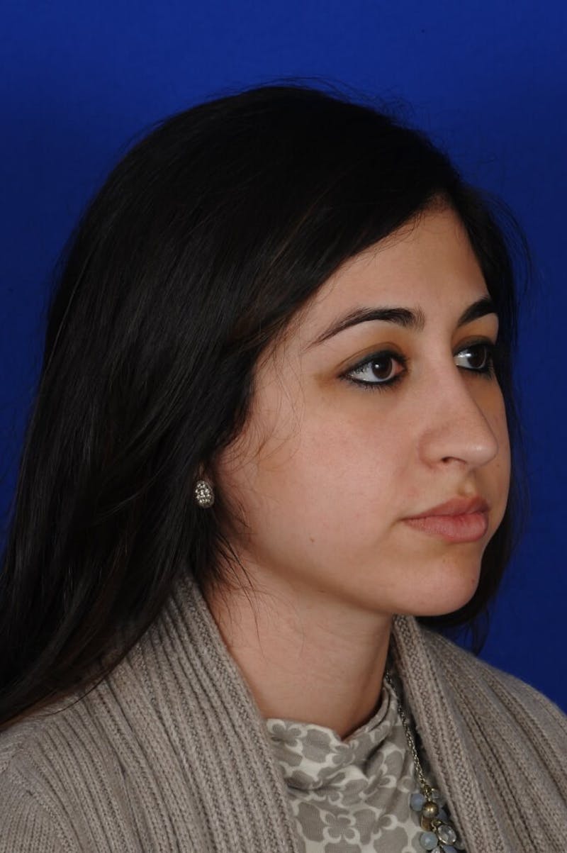 Rhinoplasty Before & After Gallery - Patient 126253 - Image 4