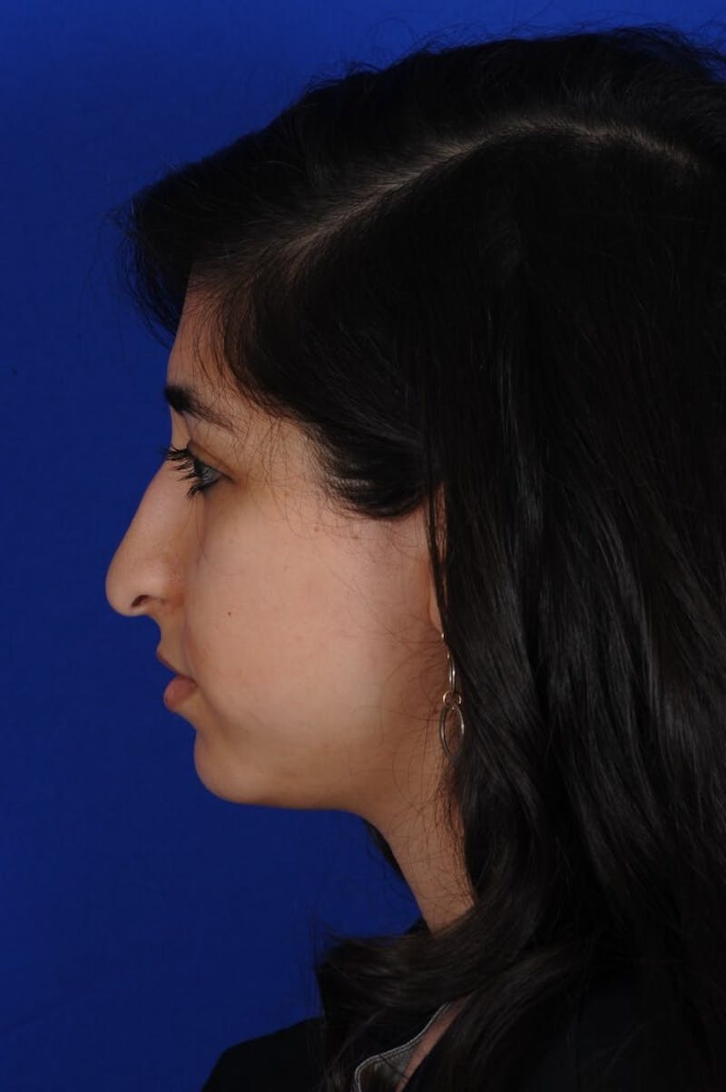 Rhinoplasty Before & After Gallery - Patient 126253 - Image 5