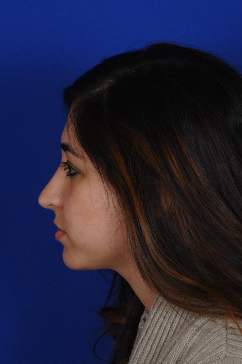 Rhinoplasty Before & After Gallery - Patient 126253 - Image 6