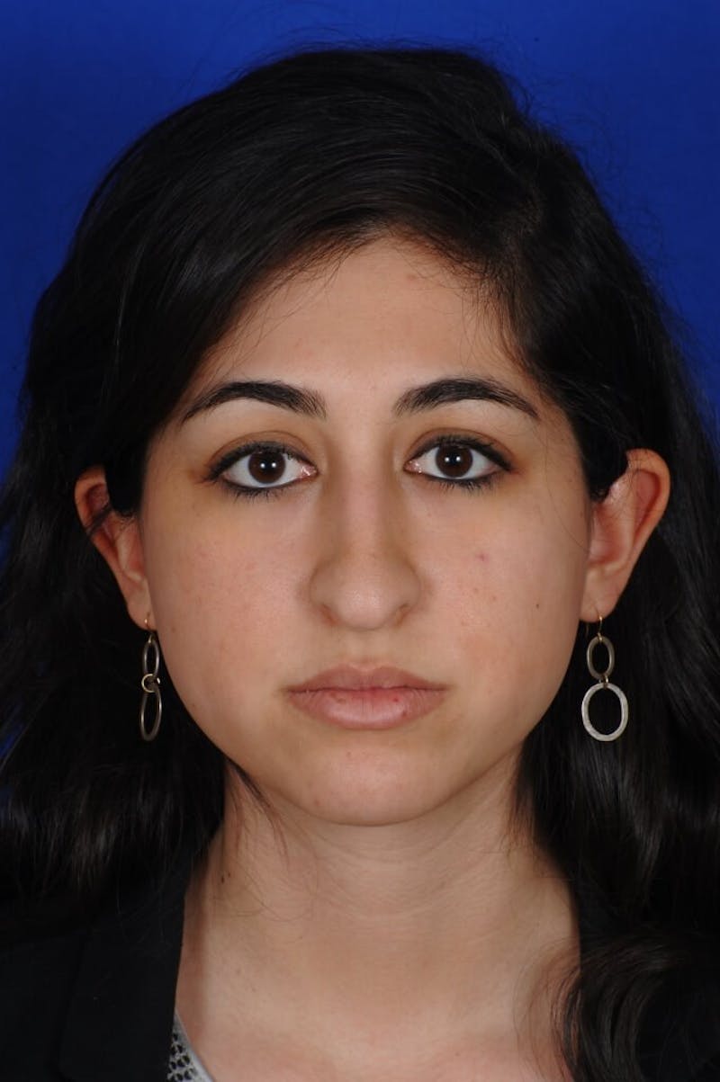 Rhinoplasty Before & After Gallery - Patient 126253 - Image 7
