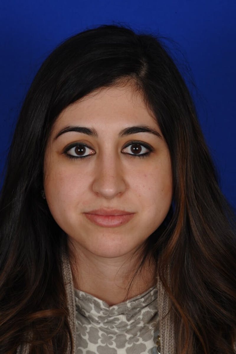 Rhinoplasty Before & After Gallery - Patient 126253 - Image 8