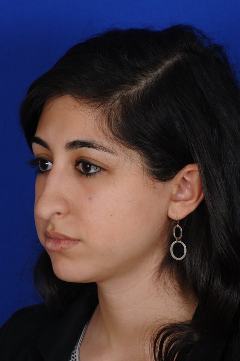 Rhinoplasty Before & After Gallery - Patient 126253 - Image 9