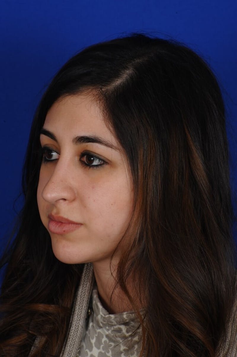 Rhinoplasty Before & After Gallery - Patient 126253 - Image 10