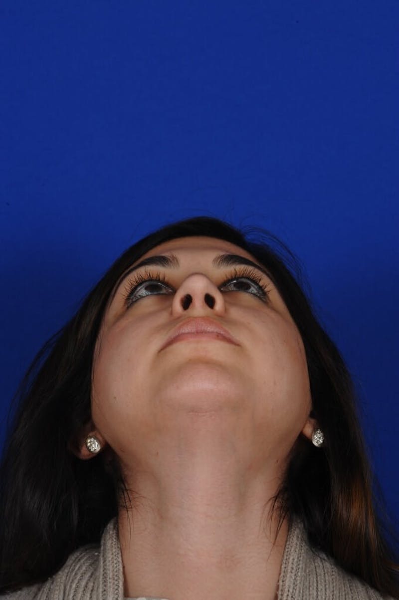 Rhinoplasty Before & After Gallery - Patient 126253 - Image 12